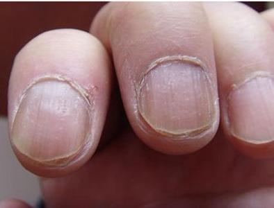生活中引起灰指甲的原因都有什么呢